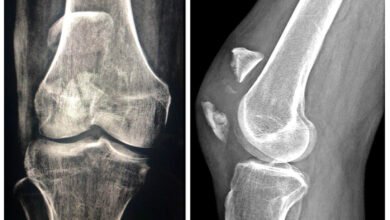 Rare Knee Complication After Patella Fracture Fixation