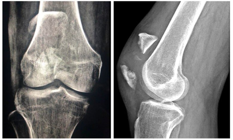 Rare Knee Complication After Patella Fracture Fixation